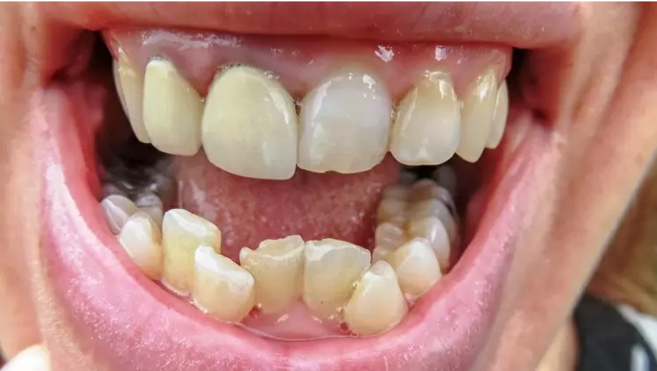 Kenapa gigi jadi tumpang tindih alias bertingkah? Berikut penyebabnya!