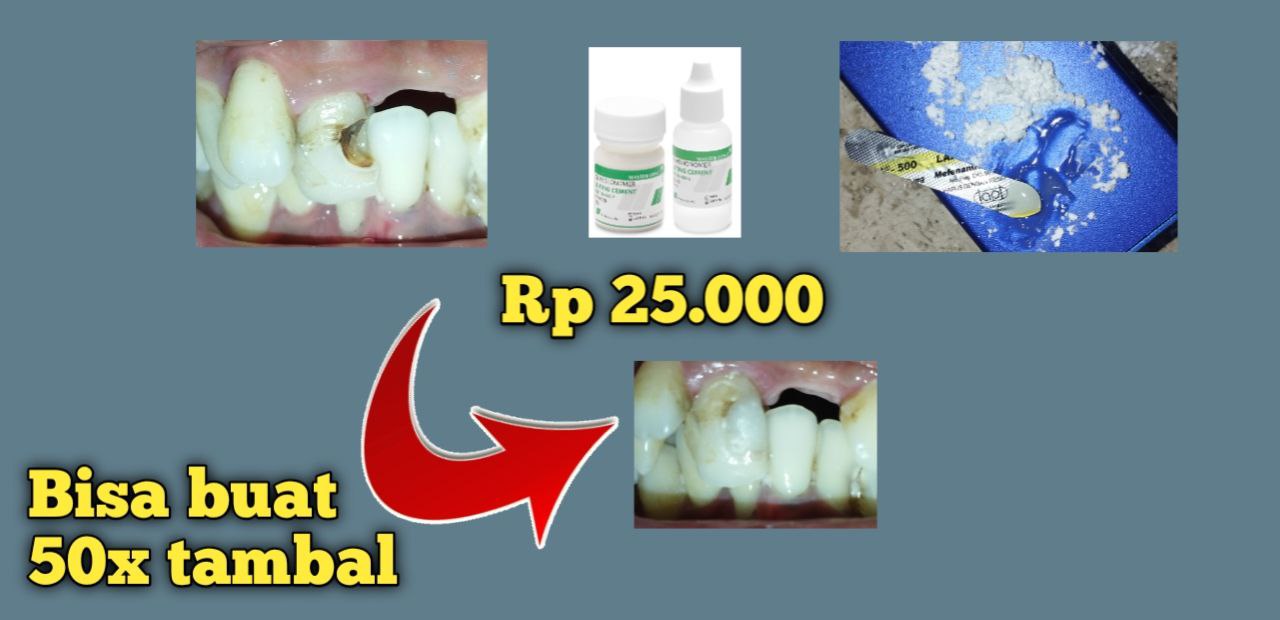 Nambal gigi mandiri dengan Glasss Ionomer, lebih murah!