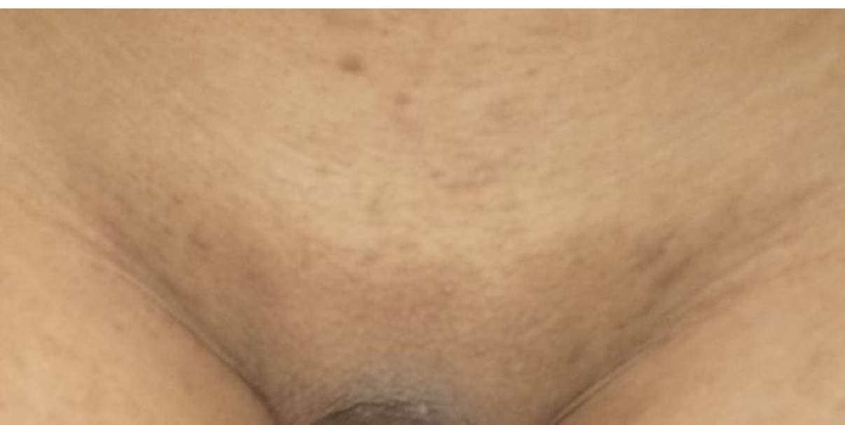 Kondisi setelah menggunakan epilator