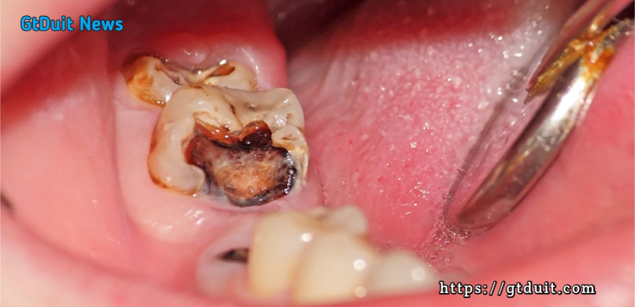 Penyebab bau mulut dan tips mengatasi bau mulut