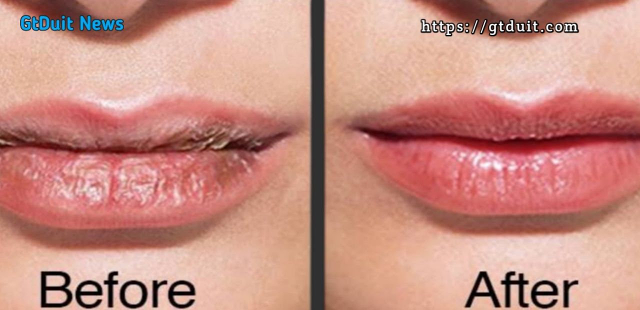 Cara mengatasi bibir kering dan pecah-pecah secara alami