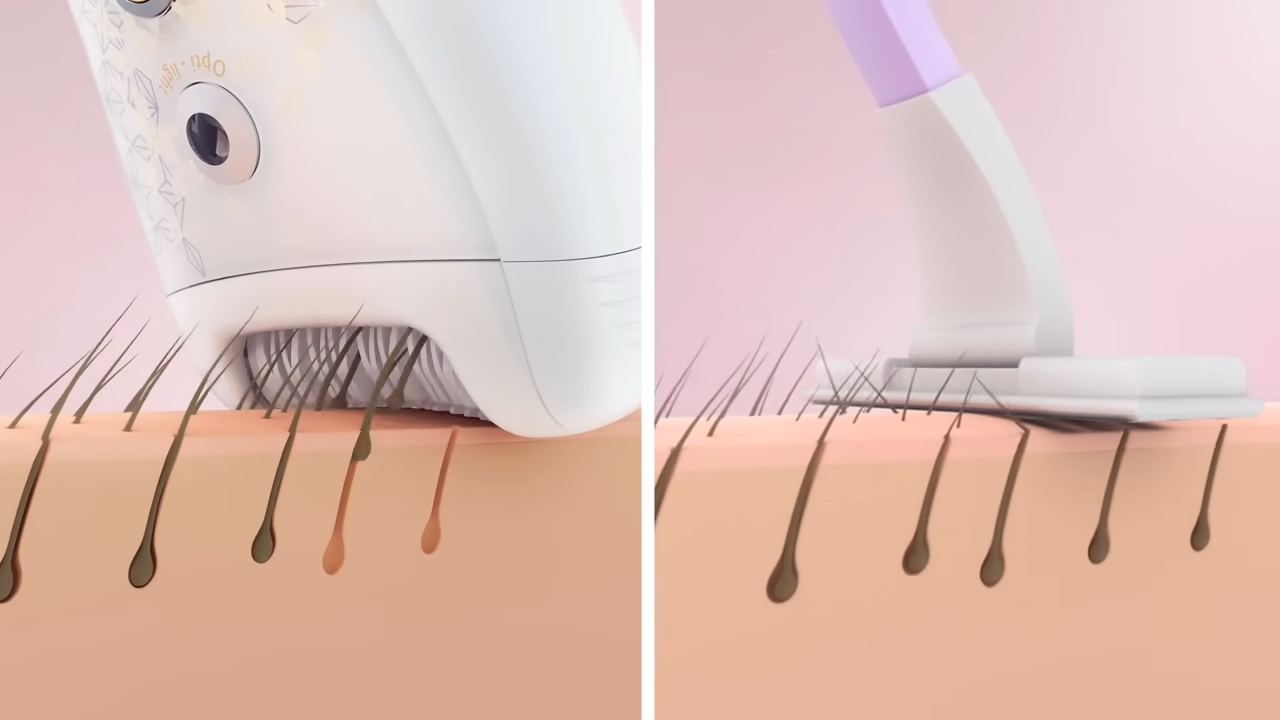 Teknologi epilator yang dapat menghilangkan bulu permanent