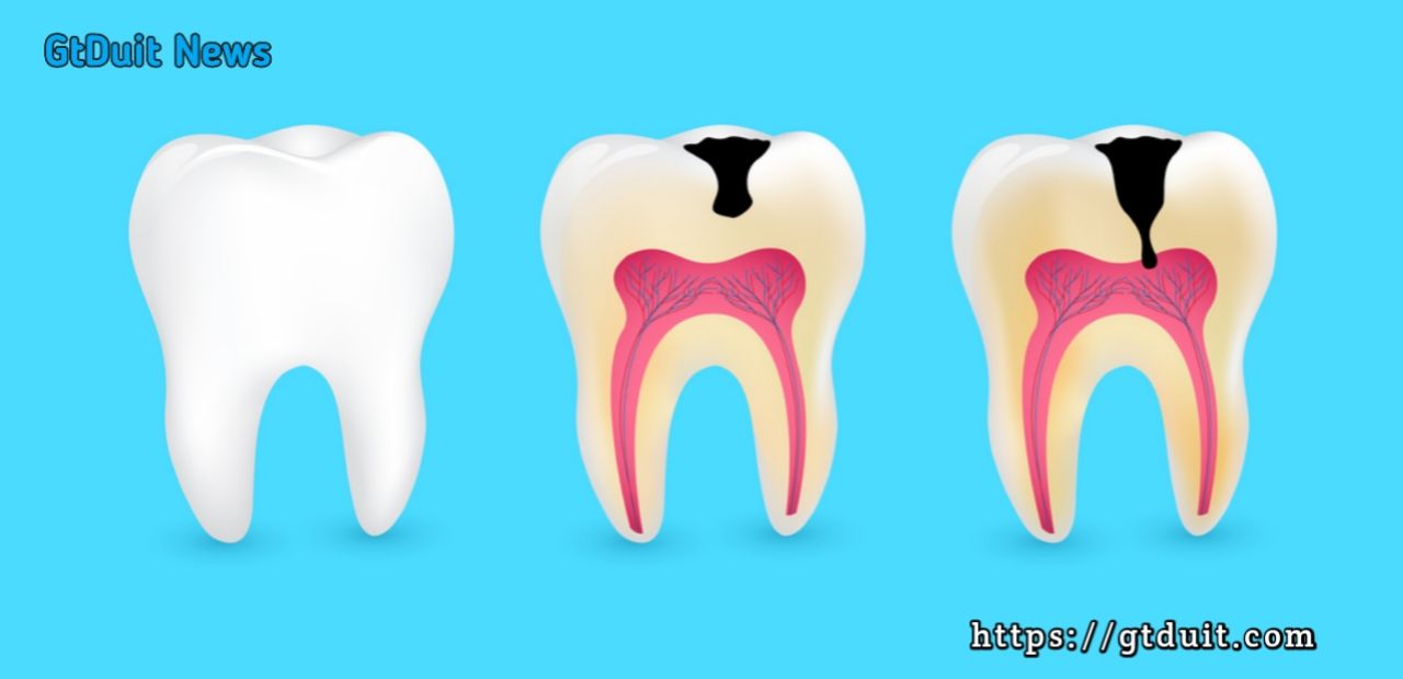 Perawatan pada karies gigi, kamu wajib tahu