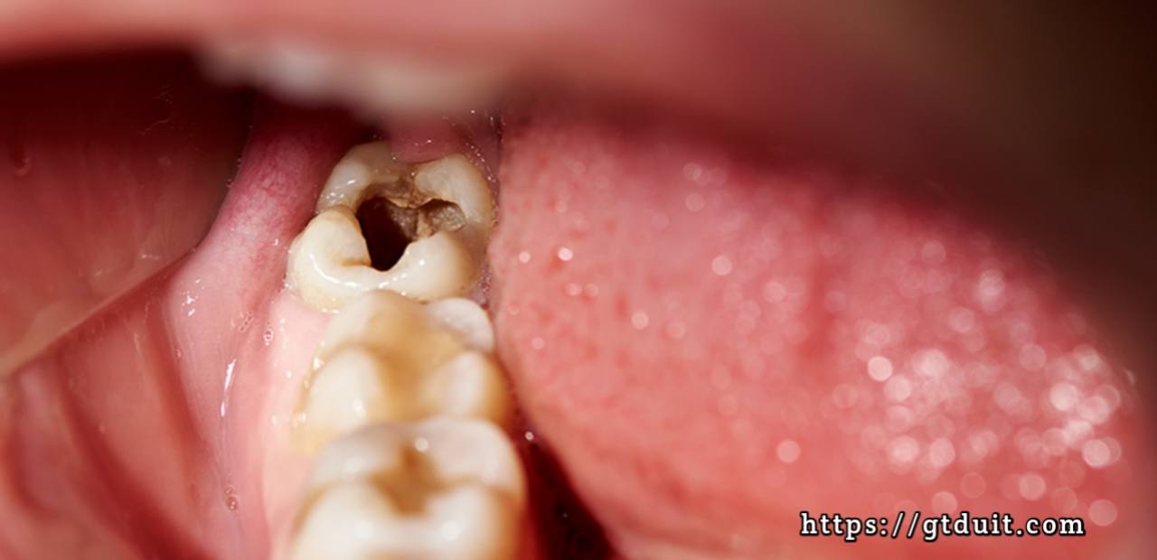 Penyebab bau mulut, dan tips mengatasi bau mulut