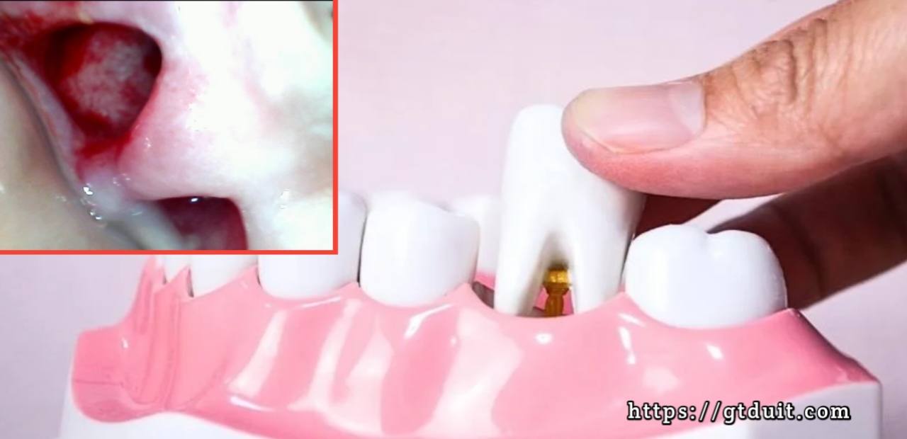 Tahapan Fase penyembuhan lubang luka bekas cabut gigi