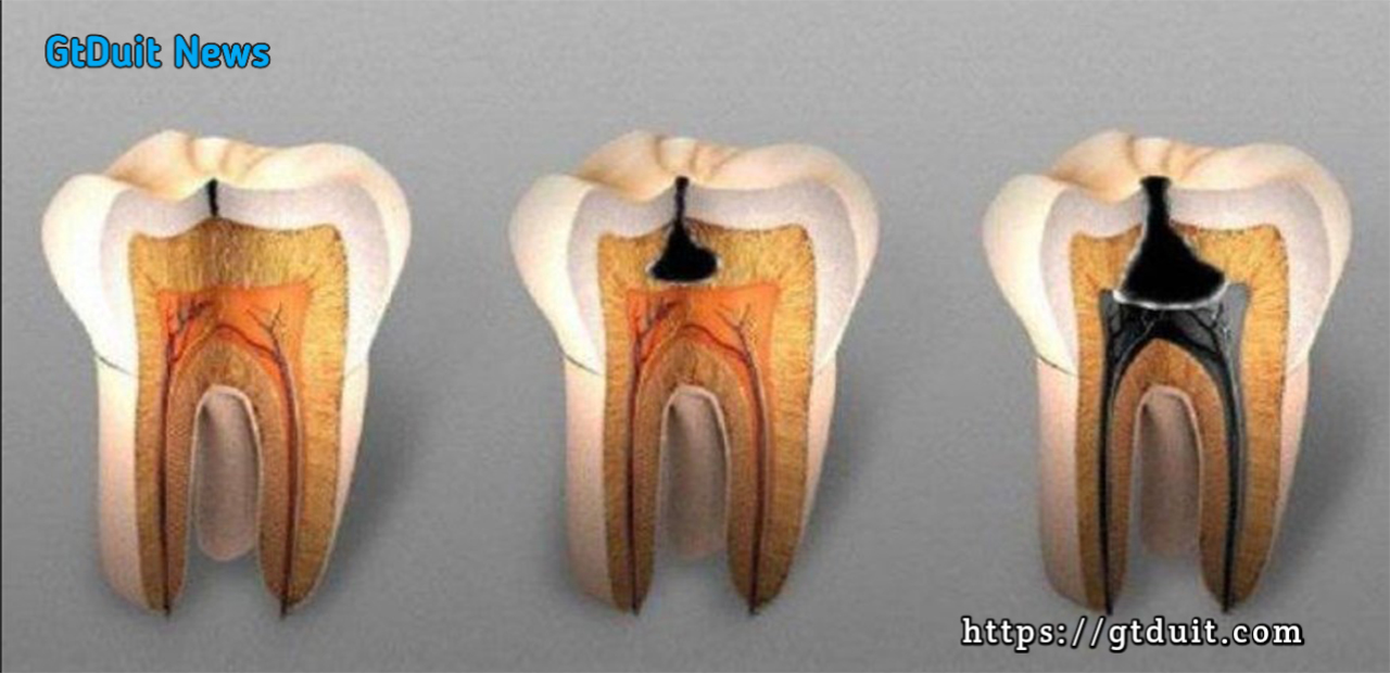 Kapan harus melakukan perawatan saluran akar gigi?