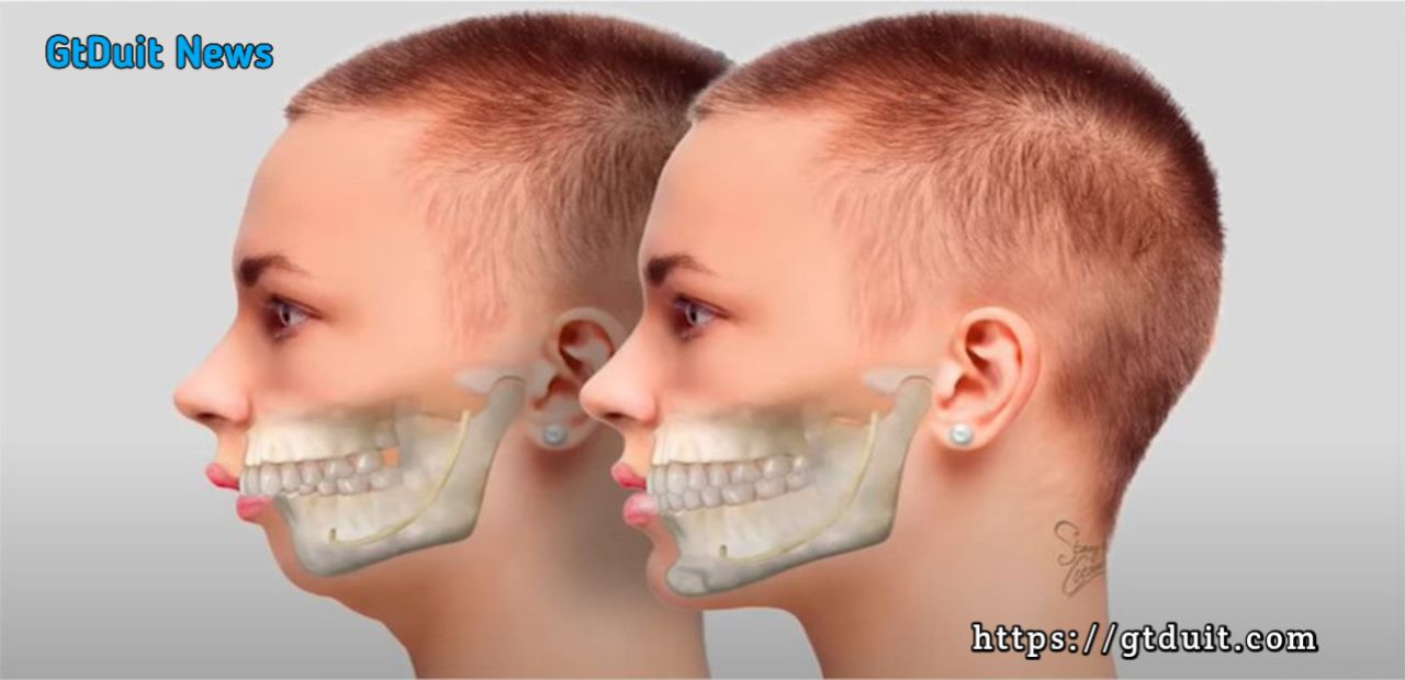 Penyebab susunan tulang rahang maju ke depan