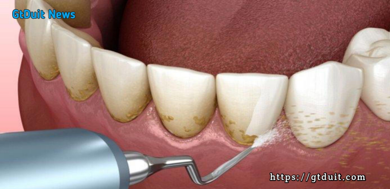 Biaya scaling gigi pada dokter gigi ( klinik kesehatan )