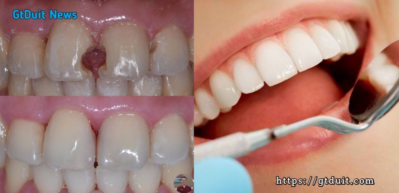 Biaya tambal gigi menggunakan bahan resin komposit