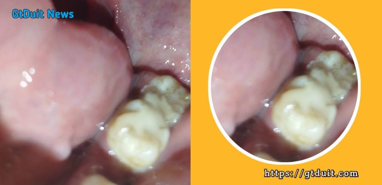 Apakah aman tambal gigi di gabung jadi satu?